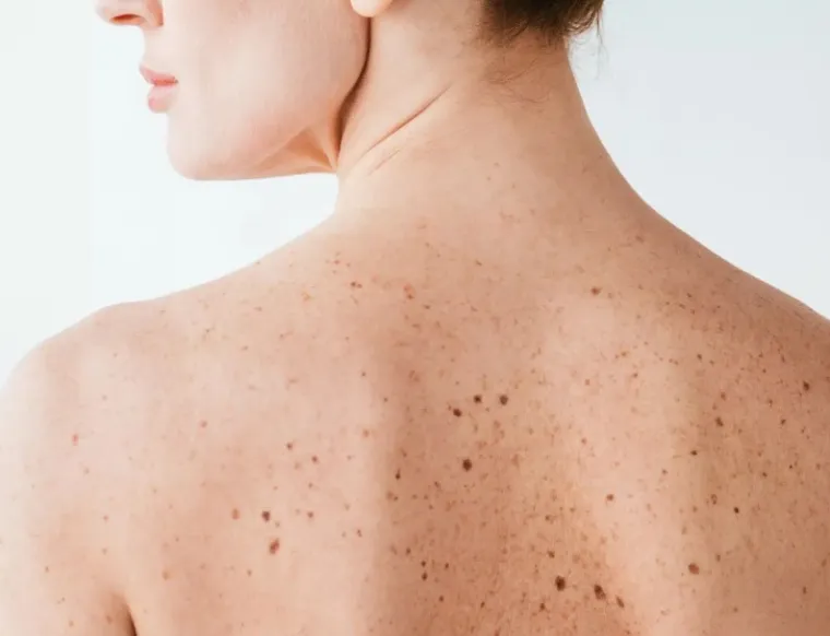La pharmacie de Roquetoire vous informe sur les grains de beauté, Roquetoire, Pharmacie de l'Avenir